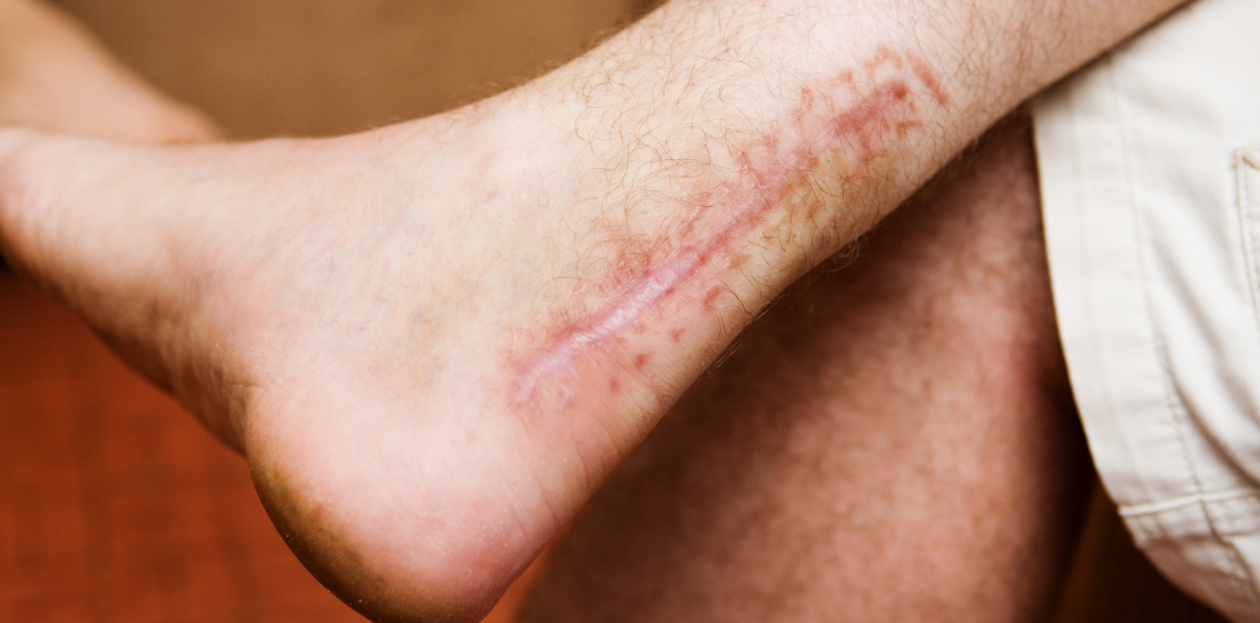 Achilles Tendon Rupture: Surgery or a Boot? – Parkside Sports Physiotherapy