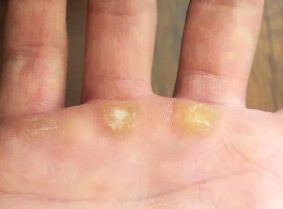 The Best Ways to Get Rid of Calluses, Fluster Buster